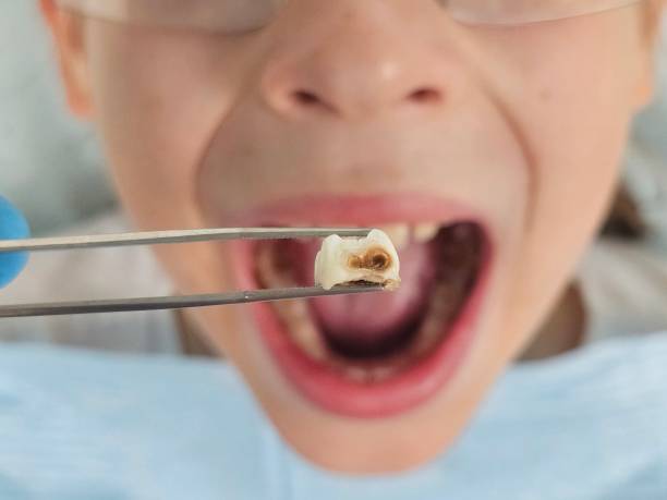 Best Emergency Broken Tooth Repair in Huntsville, TX